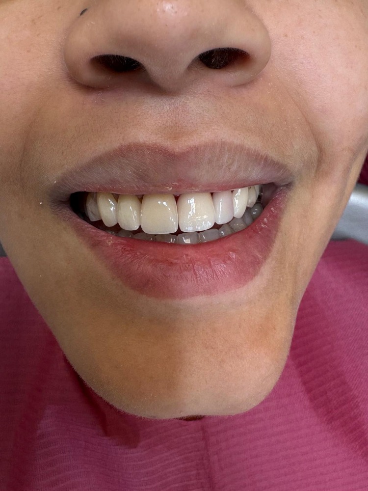 After treatment
